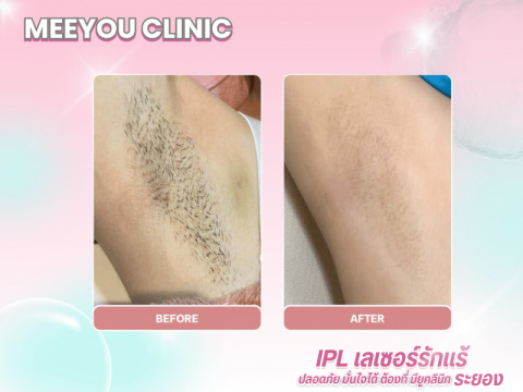 ปรับรูปหน้า ยกกระชับ เติมเต็มความอ่อนเยาว์ บริการ HIFU, โบท็อกซ์ และฟิลเลอร์ (3)